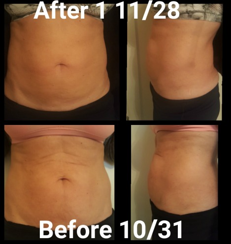 Before and After Exilis Fat Melting Treatment on Abdomen