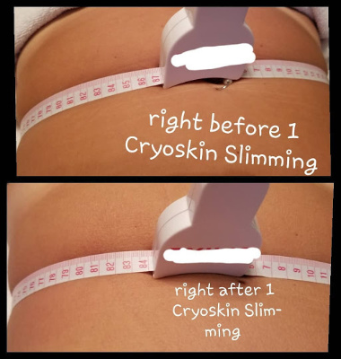 CryoSlimming