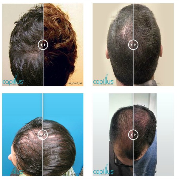 Men Before and After Capillus Hair Loss Treatment