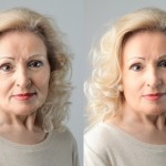 Photo Before After Injectable Filler