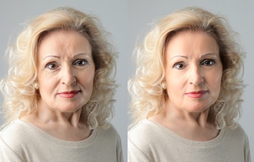 Photo Before After Injectable Filler