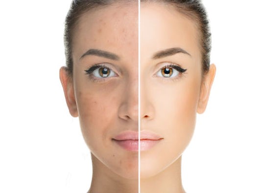 Before and after Dermaplane and IPL Photo Facial