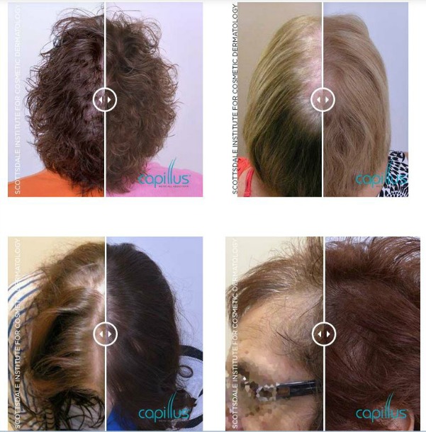 Women Before and After Capillus Hair Loss Treatment
