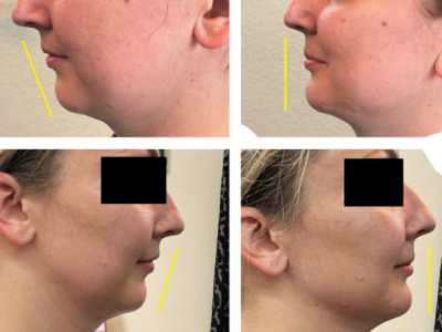 before and after injectable filler for chin