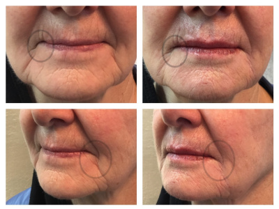 before and after injectable filler for wrinkles