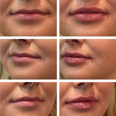 before and after injectable filler for plumper lips