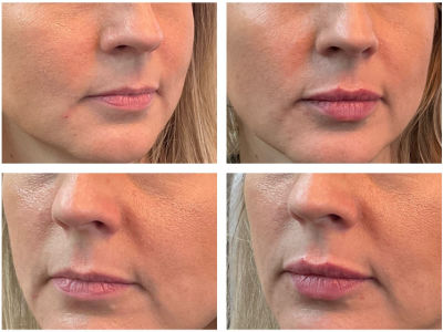 before and after injectable filler for lips