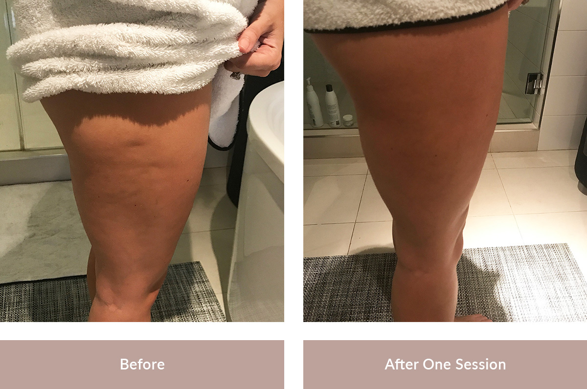 get rid of cellulite on legs