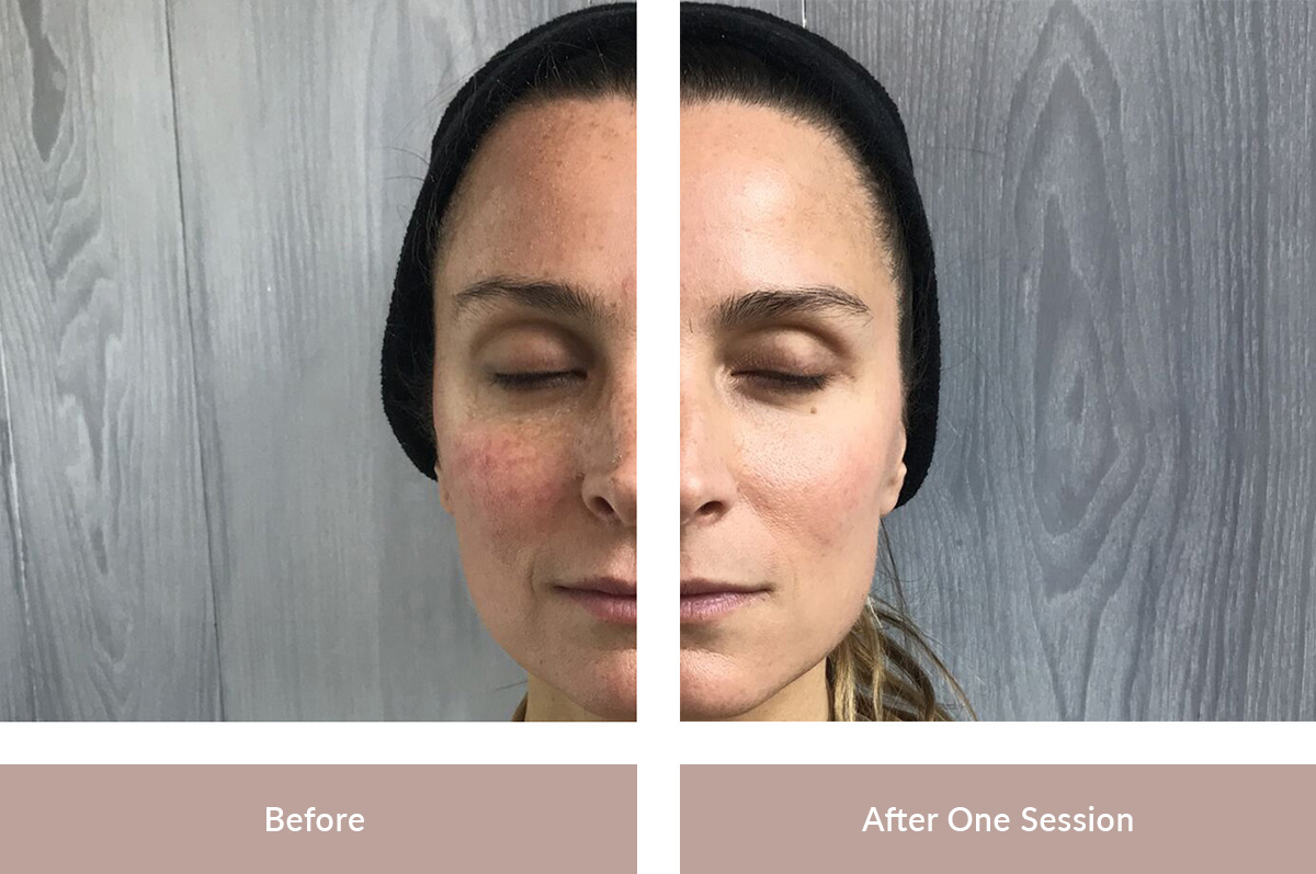 skin toning facial technology