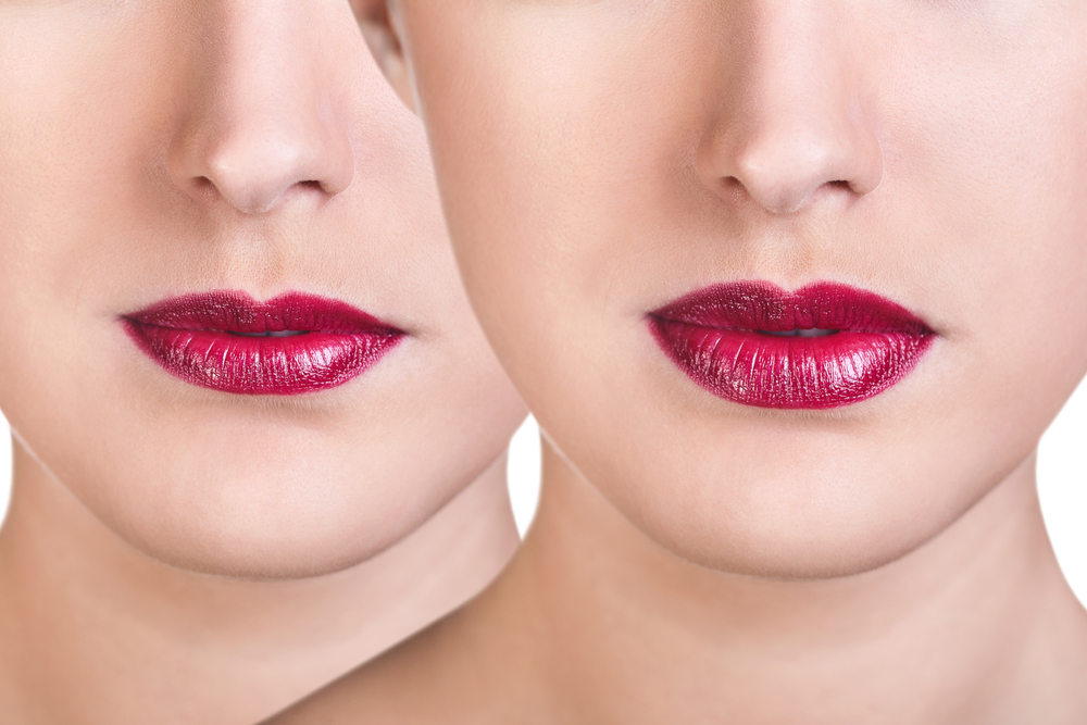 Before And After Lip Filler Injections Willow Health And Aesthetics
